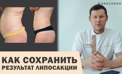 липосакция как сохранить результат