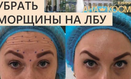 морщины на лбу