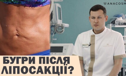 Як не отримати бугри після ліпосакції